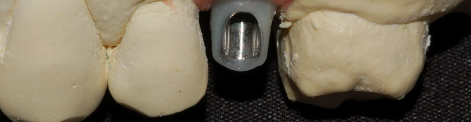 Abutment in disilicato di litio