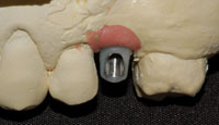 Abutment in disilicato di litio