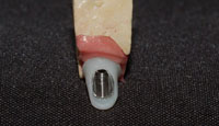 Abutment in disilicato di litio