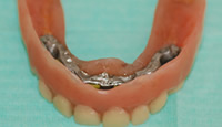 overdenture