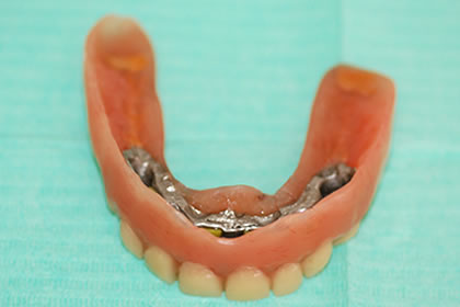 overdenture